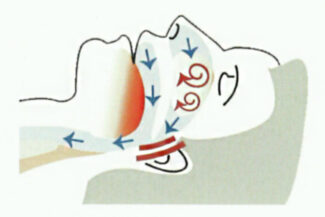 Was passiert beim Schnarchen